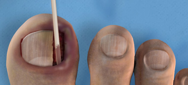 Ingrown Toenail Removal Surgery Surgerysquad