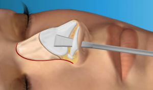closed-rhinoplasty