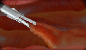 appendectomy