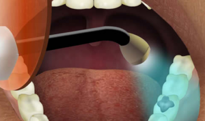 dental-filling