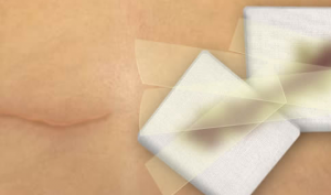double-mastectomy