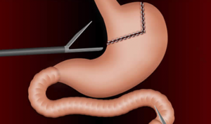 gastric-bypass