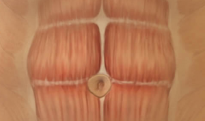 tumescent-liposuction