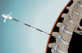 Child Birth with Epidural