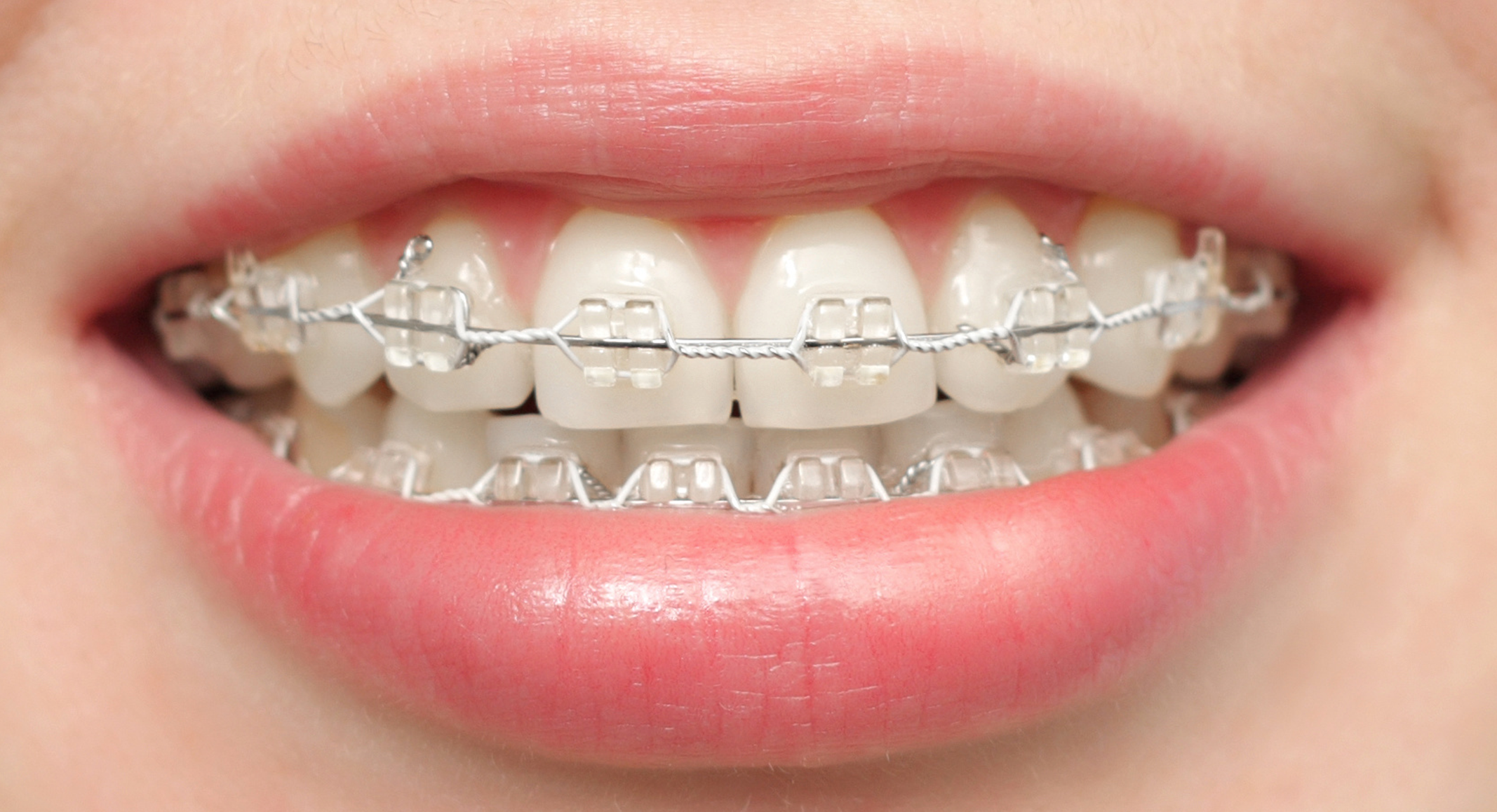 Surgery Squad Ceramic Braces Surgery Squad