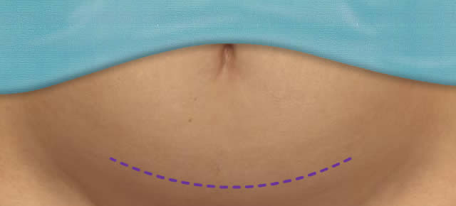 C-Section