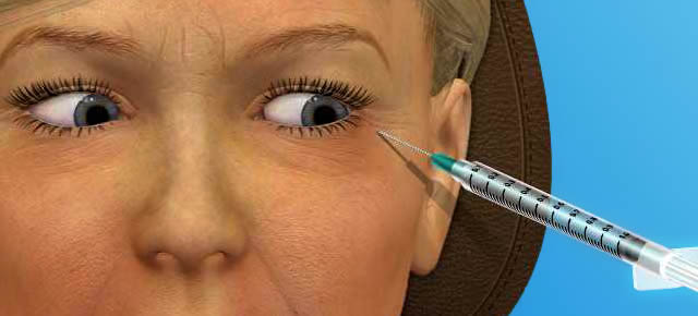 Botox Injections