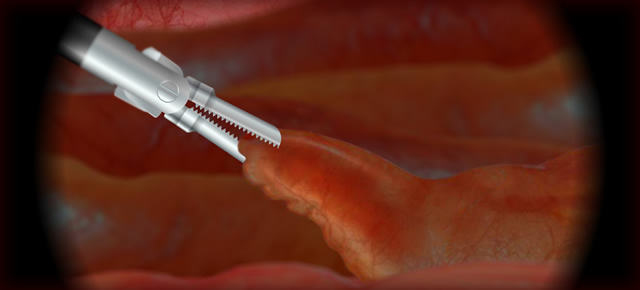 Laparoscopic Appendectomy
