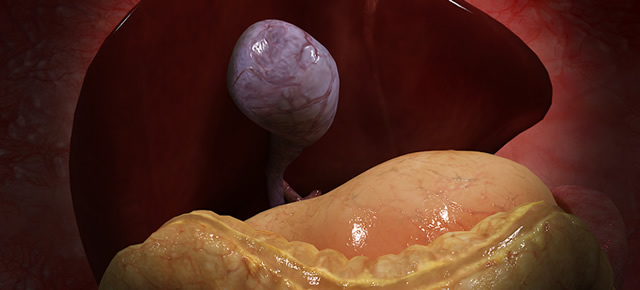 Laparoscopic Gallbladder Surgery