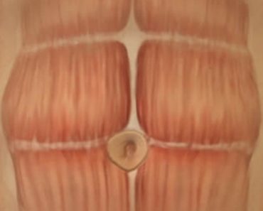 Surgery Squad Tumescent Liposuction Surgery