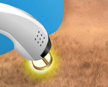 Surgery Squad Laser Hair Removal Procedure