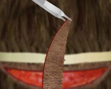 Surgery Squad Hair Transplant Surgery