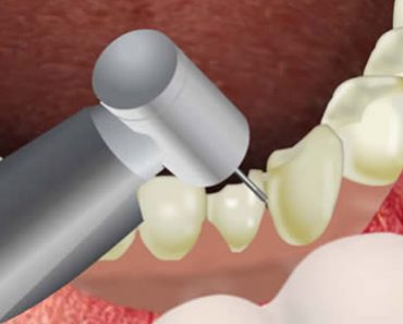 Surgery Squad Dental Crown Surgery