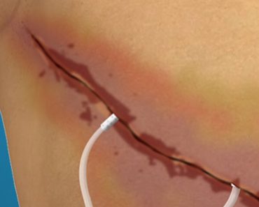 Surgery Squad Mastectomy Surgery