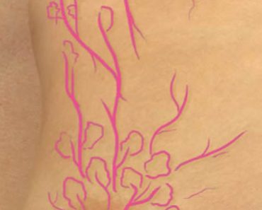 Surgery Squad Breast Cancer Awareness