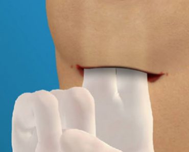 Surgery Squad Silicone Breast Implant Surgery