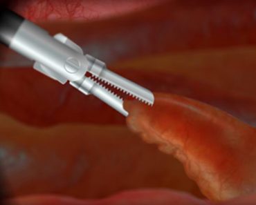 Surgery Squad Laparoscopic Appendectomy Surgery