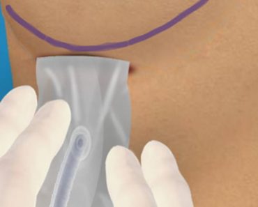 Surgery Squad Saline Breast Implant Surgery