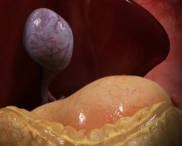 Surgery Squad Laparoscopic Gallbladder Surgery