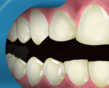 Surgery Squad Teeth Whitening