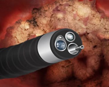 Surgery Squad Adenoidectomy Surgery