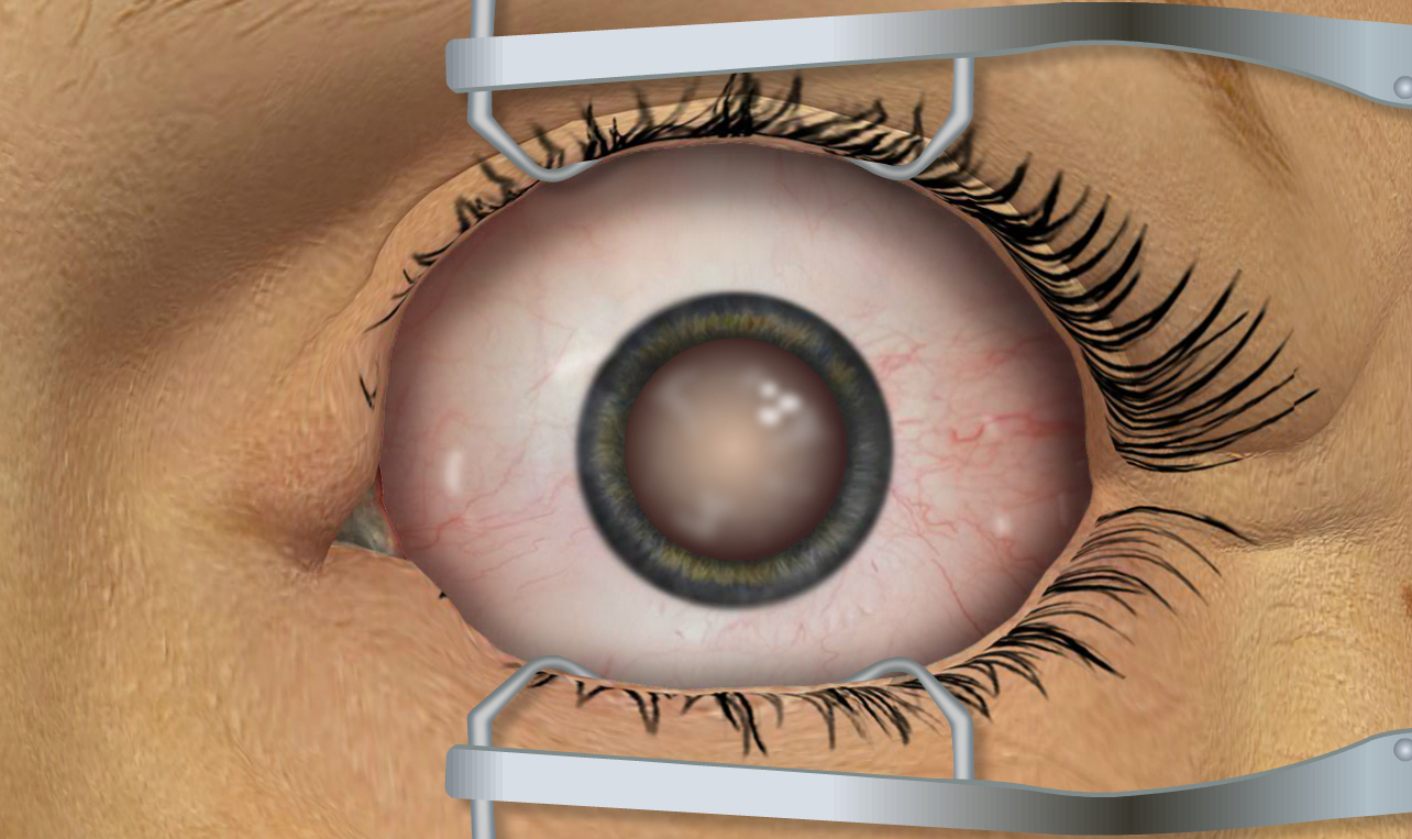 Cataract Eye Surgery on Coming Soon! Surgery Squad
